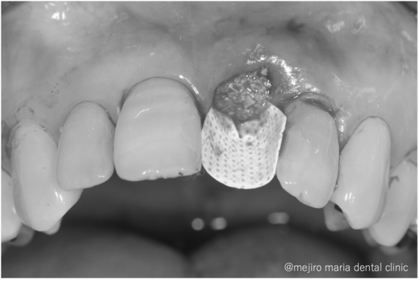 目白マリア歯科｜歯周形成外科の症例｜【症例】抜歯後の歯茎の凹みを低侵襲で予防し、接着性ブリッジを用いてインプラントを回避 歯槽堤保存術（Alveolar Ridge Preservation ; ARP） ｜切開後しょ