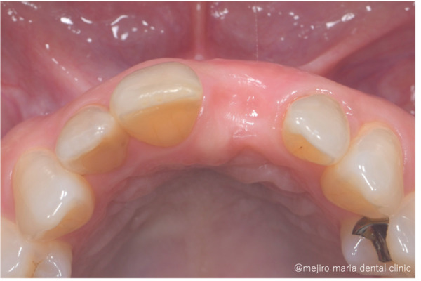 目白マリア歯科｜歯周形成外科の症例｜【症例】抜歯後の歯茎の凹みを低侵襲で予防し、接着性ブリッジを用いてインプラントを回避 歯槽堤保存術（Alveolar Ridge Preservation ; ARP） ｜凹み