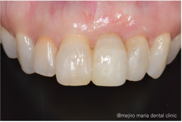 目白マリア歯科｜歯周形成外科の症例｜【症例】抜歯後の歯茎の凹みを低侵襲で予防し、接着性ブリッジを用いてインプラントを回避 歯槽堤保存術（Alveolar Ridge Preservation ; ARP） ｜治療詳細治療後