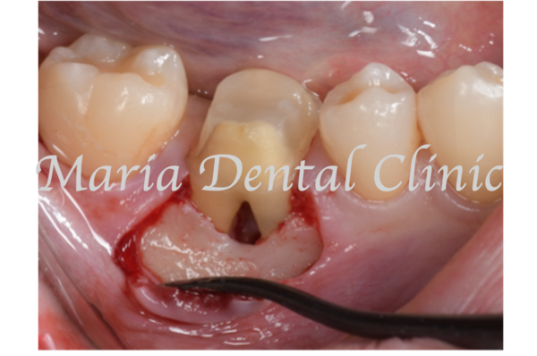 	目白マリア歯科｜歯周形成外科の症例｜【症例】難症例・根の病気と歯周病が併発した症例２（世界基準の精密根管治療と最先端の歯周組織再生療法を用いて全ての問題を解決）｜術中