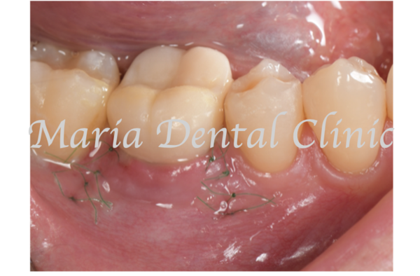 	目白マリア歯科｜歯周形成外科の症例｜【症例】難症例・根の病気と歯周病が併発した症例２（世界基準の精密根管治療と最先端の歯周組織再生療法を用いて全ての問題を解決）｜縫合後