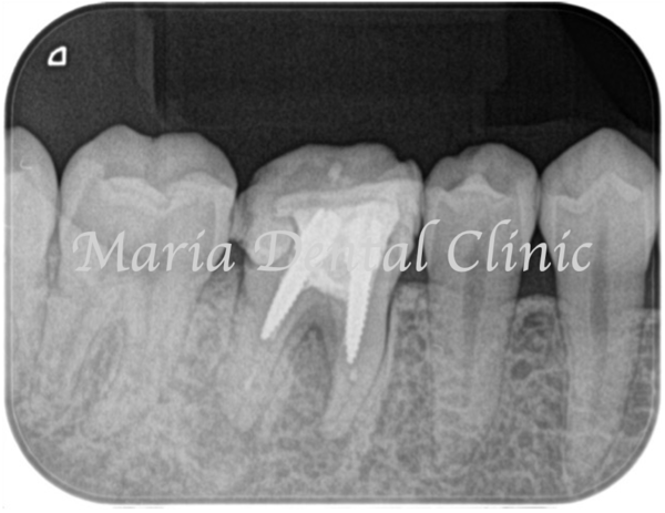 目白マリア歯科｜歯周形成外科の症例｜【症例】難症例・根の病気と歯周病が併発した症例２（世界基準の精密根管治療と最先端の歯周組織再生療法を用いて全ての問題を解決）｜術前レントゲン