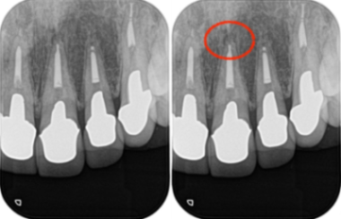 治療前レントゲン画像①｜【症例】セラミック治療後に発症した根尖性歯周炎に対する歯根端切除術｜目白マリア歯科
