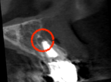 治療前レントゲン画像②｜【症例】セラミック治療後に発症した根尖性歯周炎に対する歯根端切除術｜目白マリア歯科