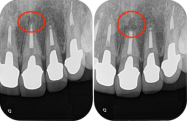 治療詳細レントゲン画像①｜【症例】セラミック治療後に発症した根尖性歯周炎に対する歯根端切除術｜目白マリア歯科