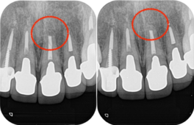 治療詳細レントゲン画像②｜【症例】セラミック治療後に発症した根尖性歯周炎に対する歯根端切除術｜目白マリア歯科