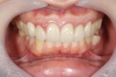 治療後画像②｜【症例】セラミック治療後に発症した根尖性歯周炎に対する歯根端切除術｜目白マリア歯科