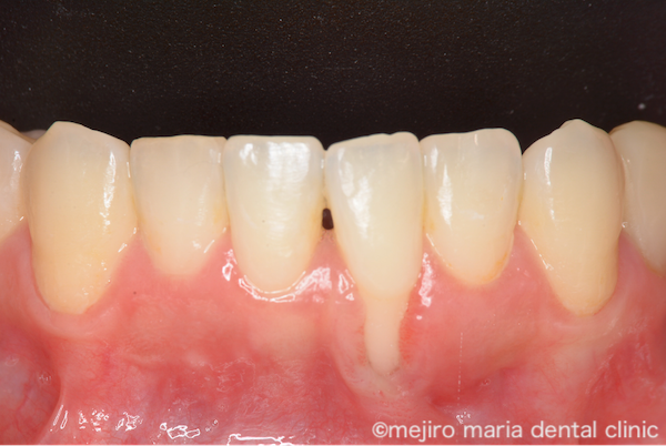 目白マリア歯科｜歯周形成外科の症例｜【症例】矯正治療による歯茎下がりを歯茎の移植で改善｜治療前の画像2