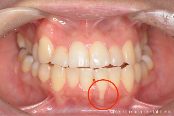 目白マリア歯科｜歯周形成外科の症例｜【症例】矯正治療による歯茎下がりを歯茎の移植で改善｜治療前の画像