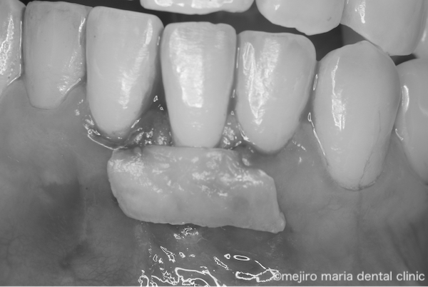 目白マリア歯科｜歯周形成外科の症例｜【症例】矯正治療による歯茎下がりを歯茎の移植で改善｜治療中の画像