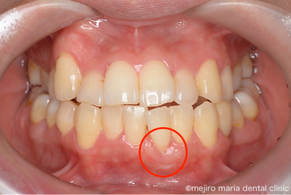 目白マリア歯科｜歯周形成外科の症例｜【症例】矯正治療による歯茎下がりを歯茎の移植で改善｜治療後の画像