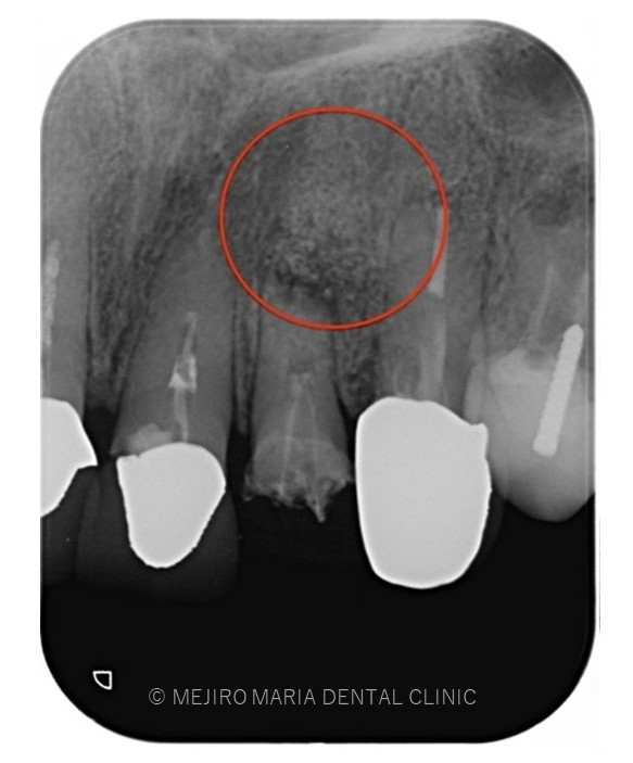 目白マリア歯科【症例】根尖部に充填された人工骨の感染により根尖性歯周炎が難治化。歯内療法（精密根管治療）でのリカバリー_治療前の口腔内画像と感染した人工骨の画像
