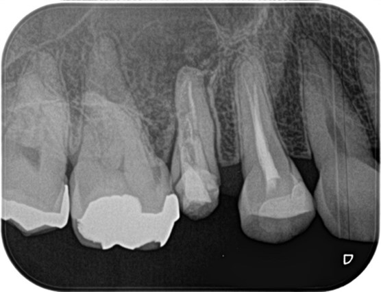 目白マリア歯科【症例】精密根管治療の費用対効果の考え方・再根管治療_治療前治療後のレントゲン画像比較