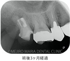 目白マリア歯科_意図的再植術0625治療後2