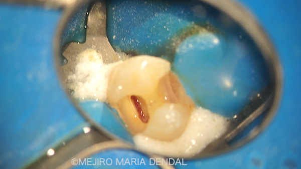 目白マリア歯科|【症例】生活歯髄断髄法（生活歯髄療法）による歯髄保存症例（精密根管治療）｜治療詳細2