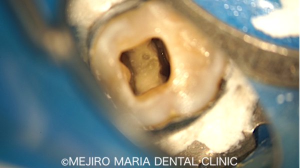 目白マリア歯科｜ブログ｜症例｜原因不明の歯の痛みを、確実な診査診断で解決（クラックトゥース編）｜治療前画像3