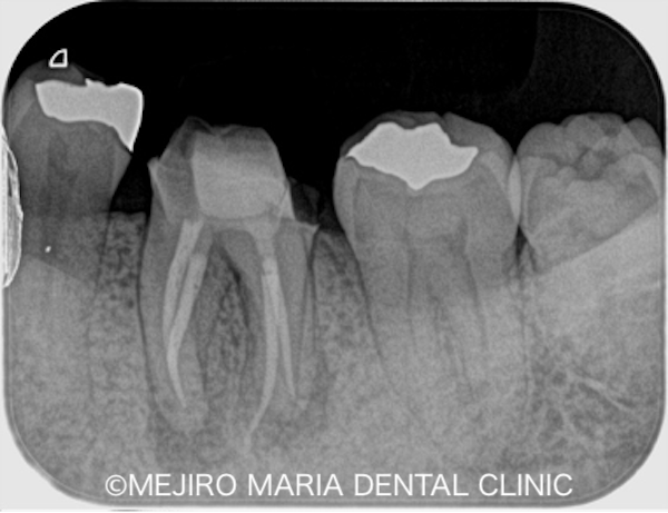 目白マリア歯科｜院長ブログ｜症例｜【症例】コンセプトを守った初回根管治療（精密根管治療）で治癒｜根管治療を開始した歯の画像_治療詳細8