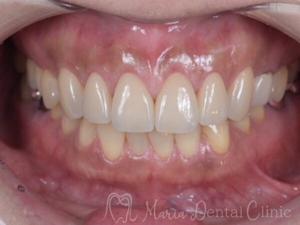 治療後の写真｜【症例】前歯の見た目を改善し自然なスマイルラインを獲得｜目白マリア歯科