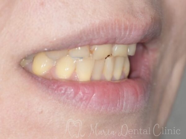 治療前の写真｜【症例】前歯の見た目を改善し自然なスマイルラインを獲得｜目白マリア歯科