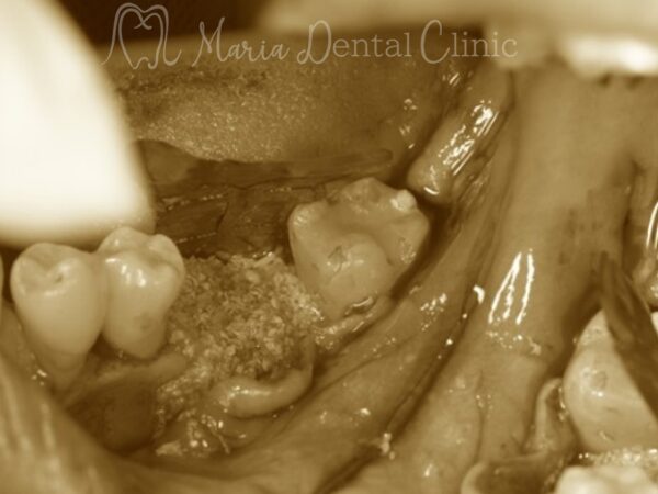 GBR術中｜【症例】抜歯後に大きく失った骨をGBR（骨造成）で再建し、清掃性と長期安定性を確保したインプラント治療｜目白マリア歯科