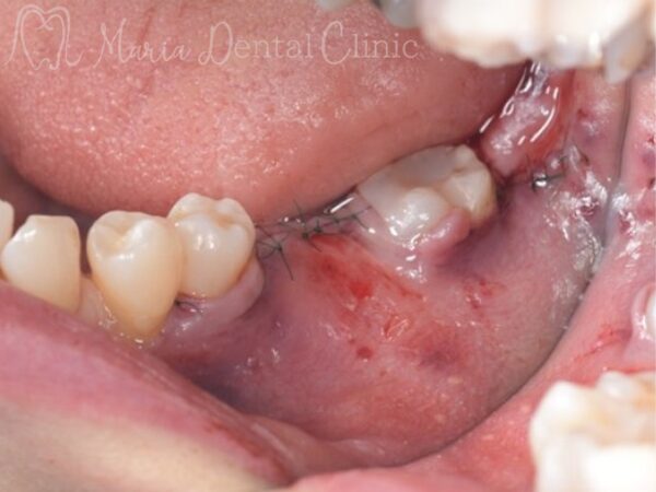 GBR直後｜【症例】抜歯後に大きく失った骨をGBR（骨造成）で再建し、清掃性と長期安定性を確保したインプラント治療｜目白マリア歯科