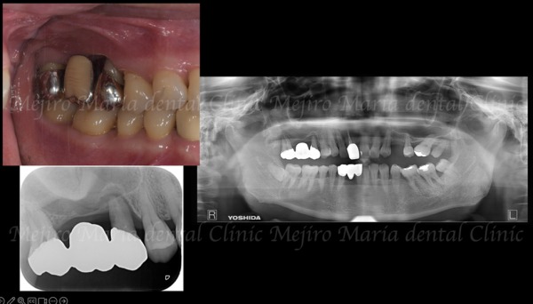 治療前の画像2｜【症例】サイナスリフトで骨を増やし奥歯の支えを回復したインプラント治療｜目白マリア歯科