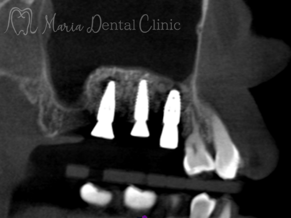 治療後の画像｜【症例】サイナスリフトで骨を増やし奥歯の支えを回復したインプラント治療｜目白マリア歯科