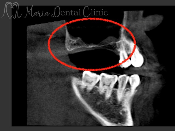 治療中の画像｜【症例】サイナスリフトで骨を増やし奥歯の支えを回復したインプラント治療｜目白マリア歯科