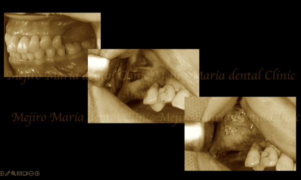 外科画像｜【症例】サイナスリフトで骨を増やし奥歯の支えを回復したインプラント治療｜目白マリア歯科