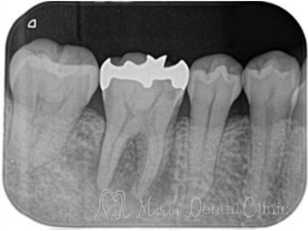 治療前｜【症例】被せ物の下で進行した虫歯に対し精密根管治療で歯質を最大限に保存 ｜目白マリア歯科