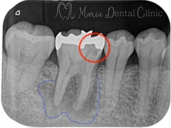 虫歯と根尖性歯周炎の箇所｜【症例】被せ物の下で進行した虫歯に対し精密根管治療で歯質を最大限に保存 ｜目白マリア歯科