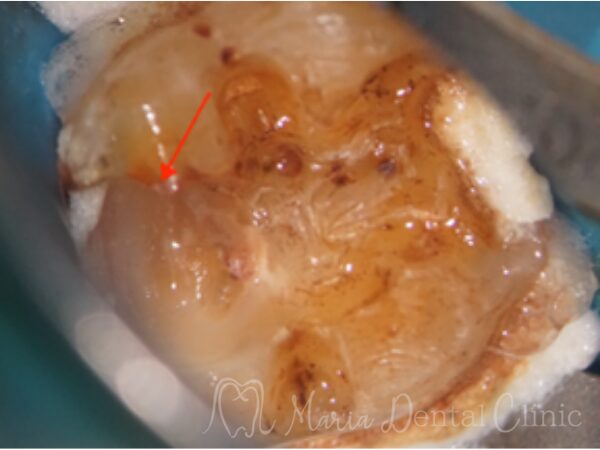 治療中画像｜【症例】被せ物の下で進行した虫歯に対し精密根管治療で歯質を最大限に保存 ｜目白マリア歯科