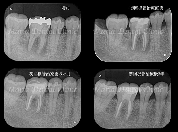 経過画像｜【症例】被せ物の下で進行した虫歯に対し精密根管治療で歯質を最大限に保存 ｜目白マリア歯科