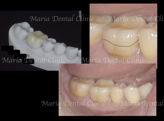 アフター画像｜【症例】被せ物の下で進行した虫歯に対し精密根管治療で歯質を最大限に保存 ｜目白マリア歯科