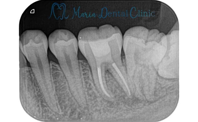 デンタルレントゲンの写真