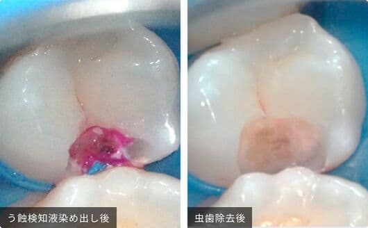 徹底的な虫歯の除去