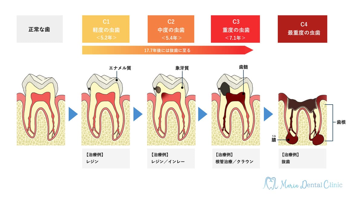 虫歯の進行の図