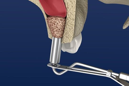 ソケットリフト