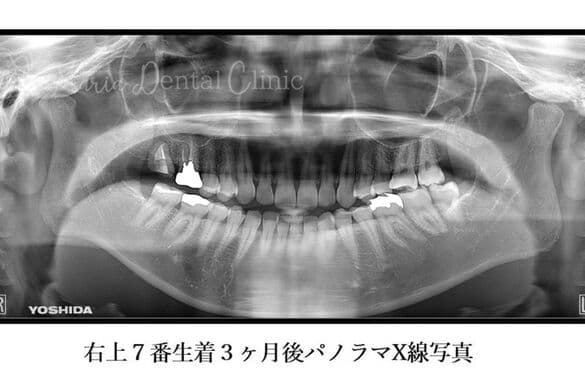 右上7番生着3ヶ月後パノラマX線写真