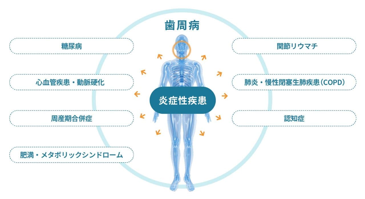 歯周病と炎症生疾患の関係図