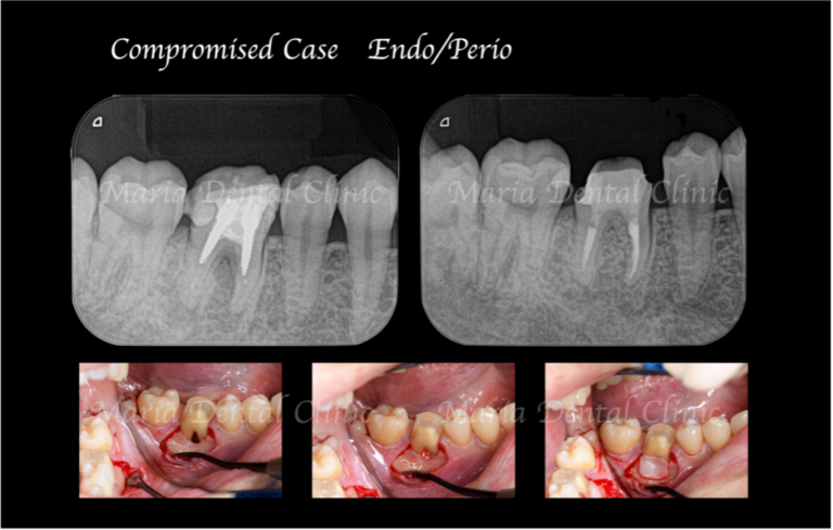 目白マリア歯科｜歯周形成外科の症例｜【症例】難症例・根の病気と歯周病が併発した症例２（世界基準の精密根管治療と最先端の歯周組織再生療法を用いて全ての問題を解決）｜アイキャッチ