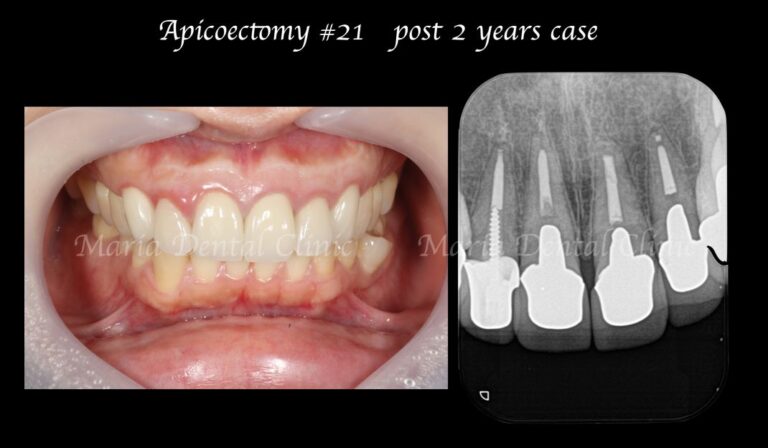 メイン画像｜【症例】セラミック治療後に発症した根尖性歯周炎に対する歯根端切除術｜目白マリア歯科