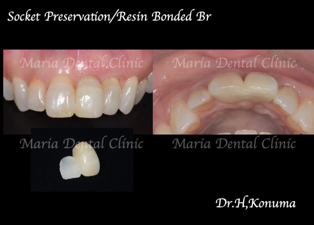 抜歯後の歯茎の凹みを低侵襲で予防し、接着性ブリッジを用いてインプラントを回避_歯槽堤保存術