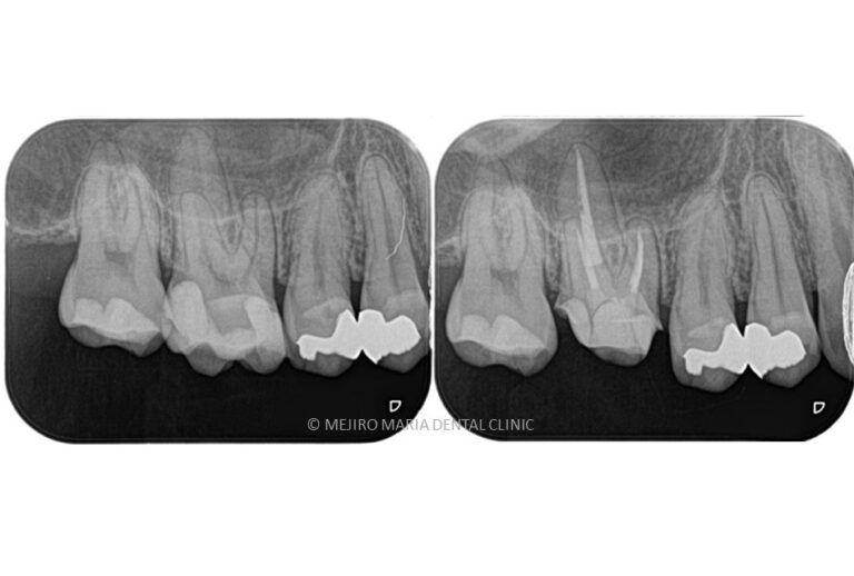 【症例】虫歯治療後の痛み、精密根管治療（抜髄）_術前術後の比較メイン画像｜目白マリア歯科