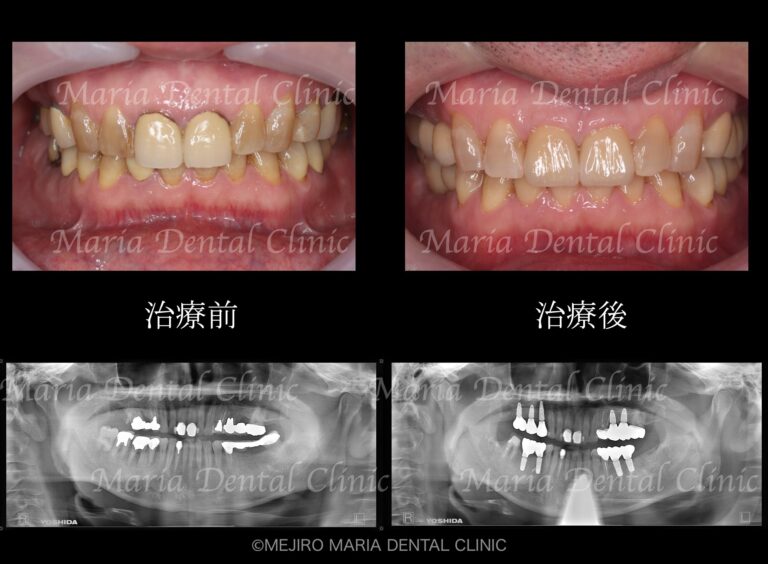 目白マリア歯科【症例】チーム医療で行った全顎的な治療：精密根管治療による歯の保存と咬合崩壊を防ぐインプラント治療｜治療前後の歯の比較画像_メイン2-1
