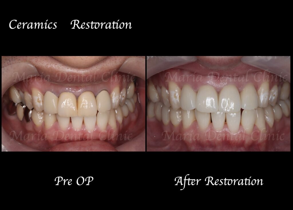 【症例】自然な美しさを実現するオールセラミックによる審美歯科治療