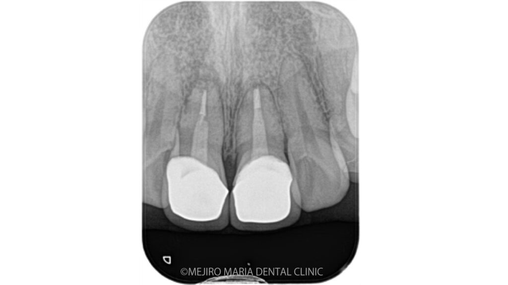 【症例】歯根端切除術の失敗をリカバリー（歯根端切除術）