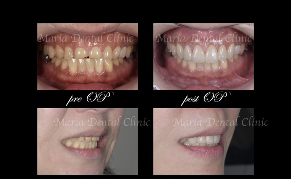 ビフォーアフター｜【症例】前歯の見た目を改善し自然なスマイルラインを獲得｜目白マリア歯科